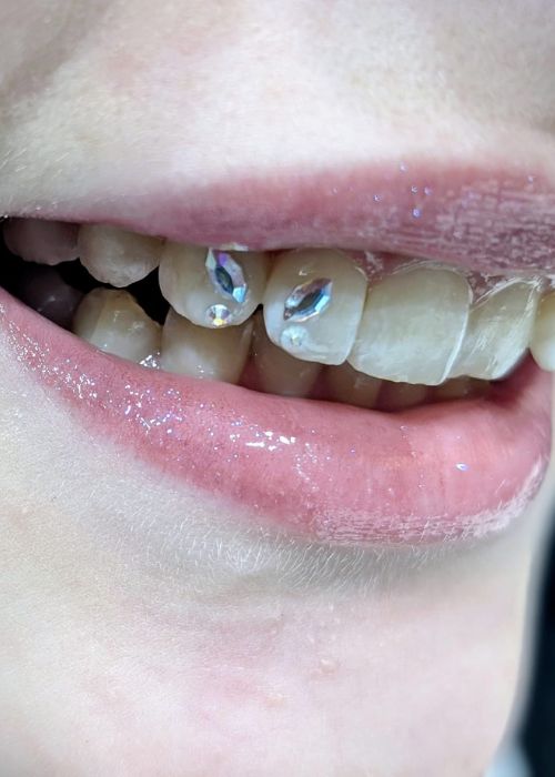 Tooth Gems Maliba Northeim