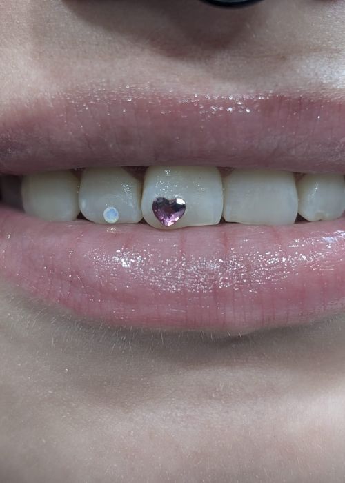 Tooth Gems Maliba Northeim