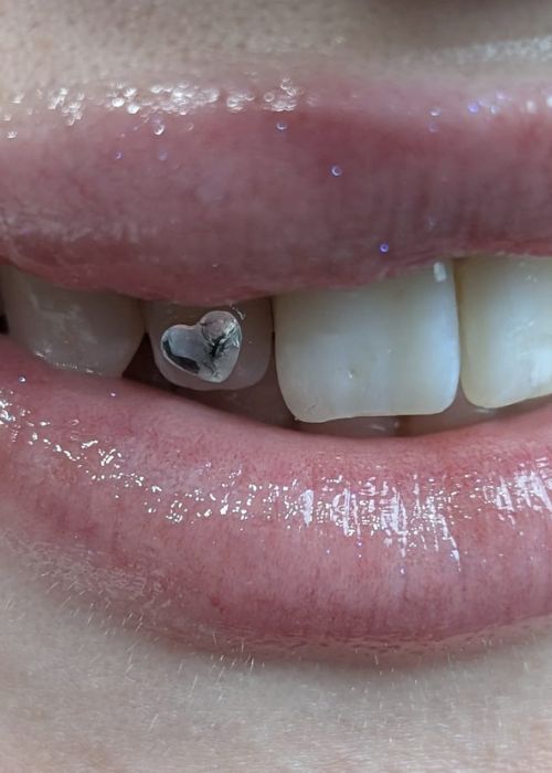 Tooth Gems Maliba Northeim
